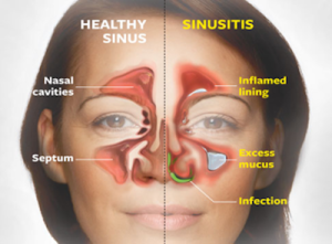 sinus infection symptoms1